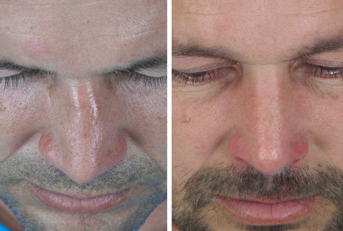 Rinoplastia en el traumatismo nasal